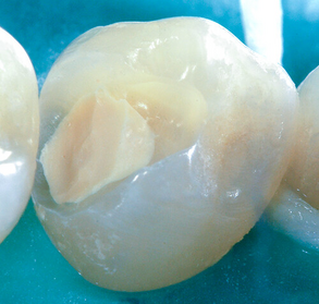 Calciumsilicaatcementen in de endodontie