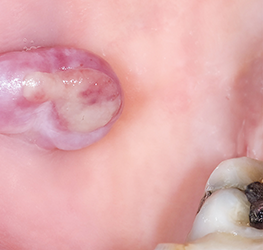 Aandoeningen van mondslijmvlies en tandvlees